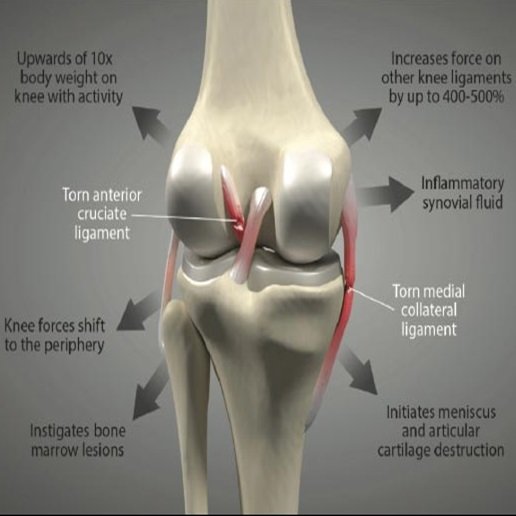 Ligament Injuries